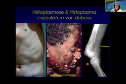 Mycologie Tropicale Pr Delhaes Laurence .mp4